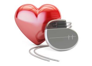 Cos’è e come funziona un pacemaker?